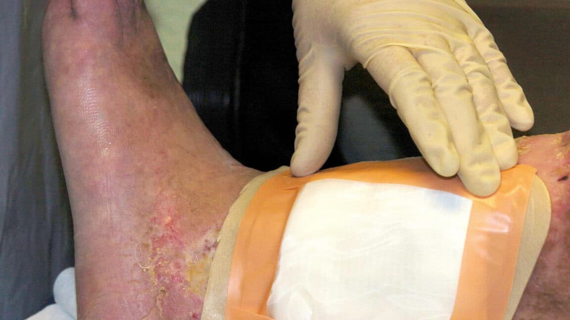 Second Fly Species Gets FDA Clearance for Maggot Wound Therapy